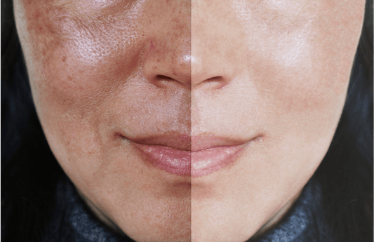 The Truth About Melasma Every Woman Needs To Know