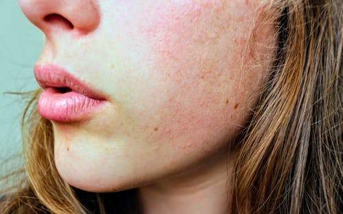 Different Types of Hyperpigmentation and How to Treat Them